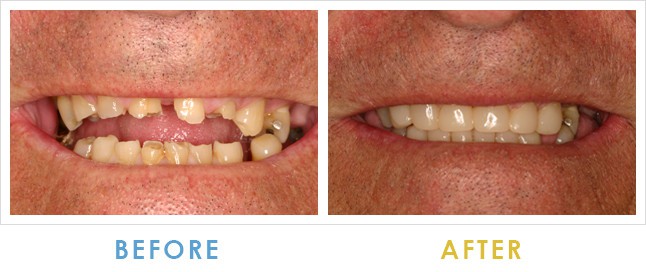 before and after dental implants - Replace Missing Teeth with Dental Implants