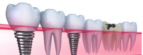 10-Incredibly-Useful-Facts-about-Dental-Implants-That-You-May-Not-Know