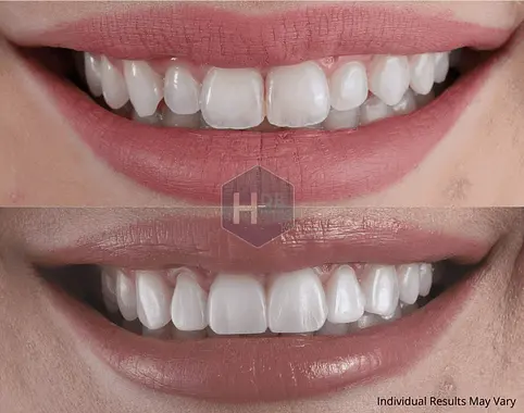 Smile fast after before haris boutique dental