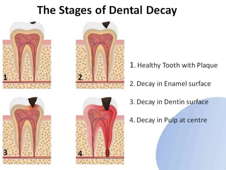 Dental-Decay-Stages