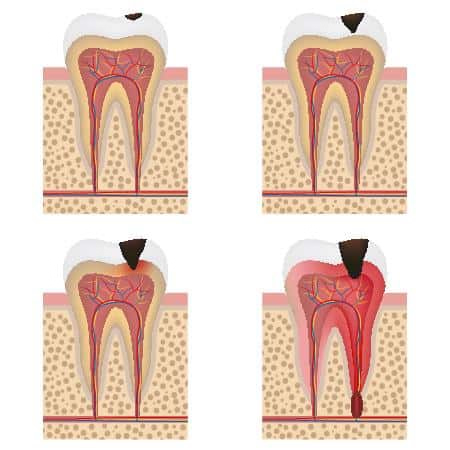 Dental-Decay