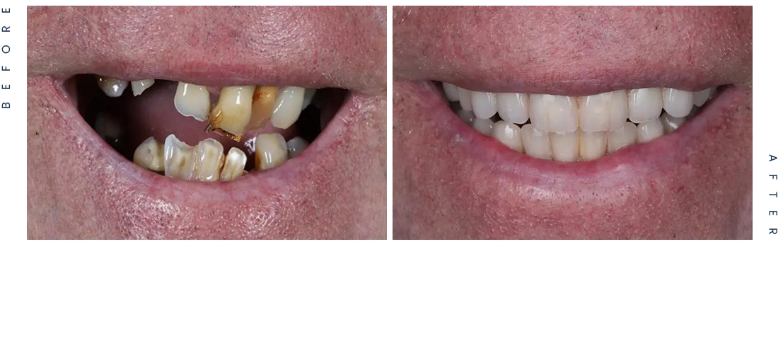 Don-after-Before - Harris Boutique Dental