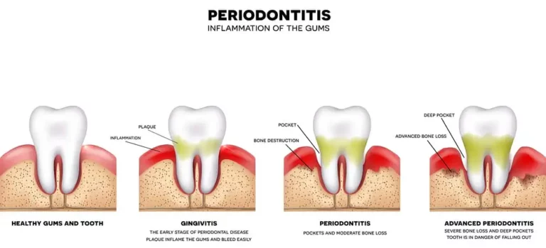 Gum Disease