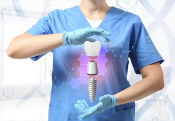 Cheapest-Dental-Implants-In-Australia-image-bargara