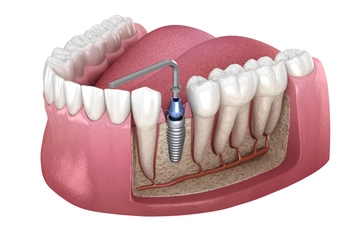 out of the country dental implant bargara