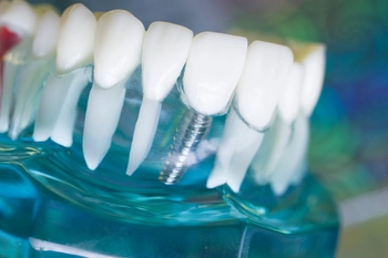 tooth implant seniors bargara