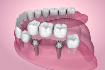 Dental Bridge Cost procedure