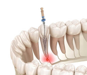 Root Canal Before and After treatment