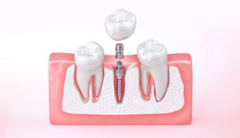 Dental Implant Kuala Lumpur placement