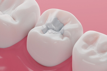 Tooth Sensitivity After a Filling procedure