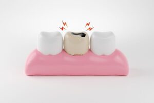 Is Fluoride Treatment Necessary decay