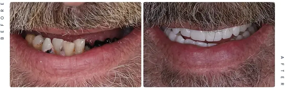 Before-and-after comparison of an upper front smile showing missing teeth and restored white teeth.