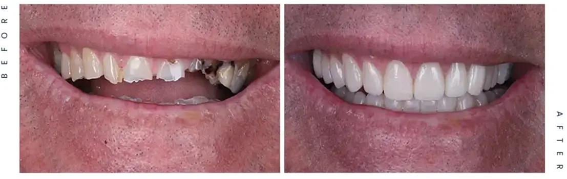 Before and after image showing broken and worn teeth before, restored teeth after