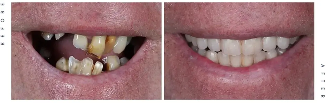 Before and after showing damaged, misaligned, and discoloured teeth replaced with teeth in both arches