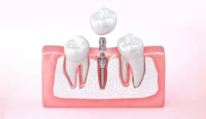 Dental Implant Fell Out parts