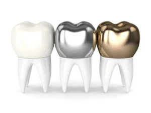 symptoms of loose dental implant crown types symptoms of loose dental implant crown types
