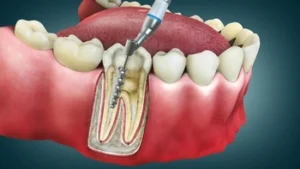 illustration of how root canal treatment happens illustration of how root canal treatment happens