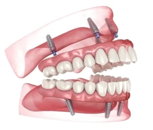 Cost For Full Mouth Dental Implants image Cost For Full Mouth Dental Implants image