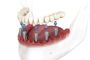 Cost for Full Mouth Dental Implants posts Cost for Full Mouth Dental Implants posts