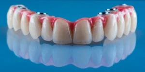 full mouth Dental Implants Payment Plans types full mouth Dental Implants Payment Plans types