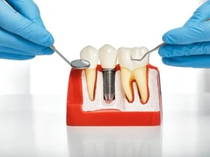 How Long Do Dental Implants Take bone graft How Long Do Dental Implants Take bone graft