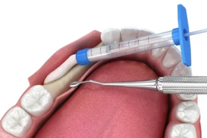 How to Speed Up Bone Graft Healing procedure How to Speed Up Bone Graft Healing procedure