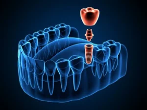3D illustration of a dental implant, abutment, and crown in a jawbone cross section. 3D illustration of a dental implant, abutment, and crown in a jawbone cross section.