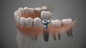 Result of a molar tooth implant installation after the surgery. Result of a molar tooth implant installation after the surgery.
