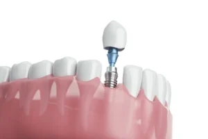 photo showing regeneration of jawbone volume, with a dental implant placed in the improved site photo showing regeneration of jawbone volume, with a dental implant placed in the improved site