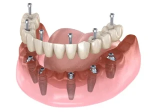 dental prosthesis that combines implant and denture dental prosthesis that combines implant and denture