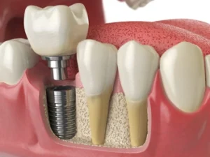 image showing the replacement of a missing tooth with a natural looking implant crown image showing the replacement of a missing tooth with a natural looking implant crown