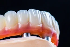 implant supported denture illustration implant supported denture illustration