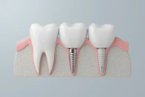 healed dental implant gum tissue healed dental implant gum tissue