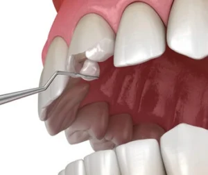 bonding broken tooth bonding broken tooth
