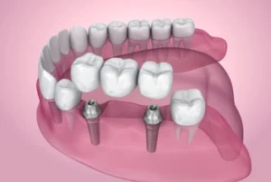 dental bridge implant dental bridge implant